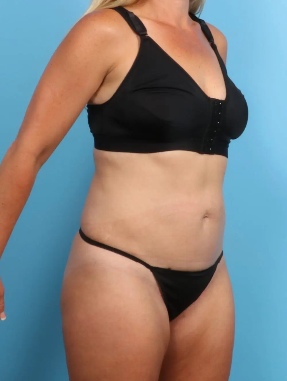 Liposuction Patient Photo - Case 20286 - before view-2