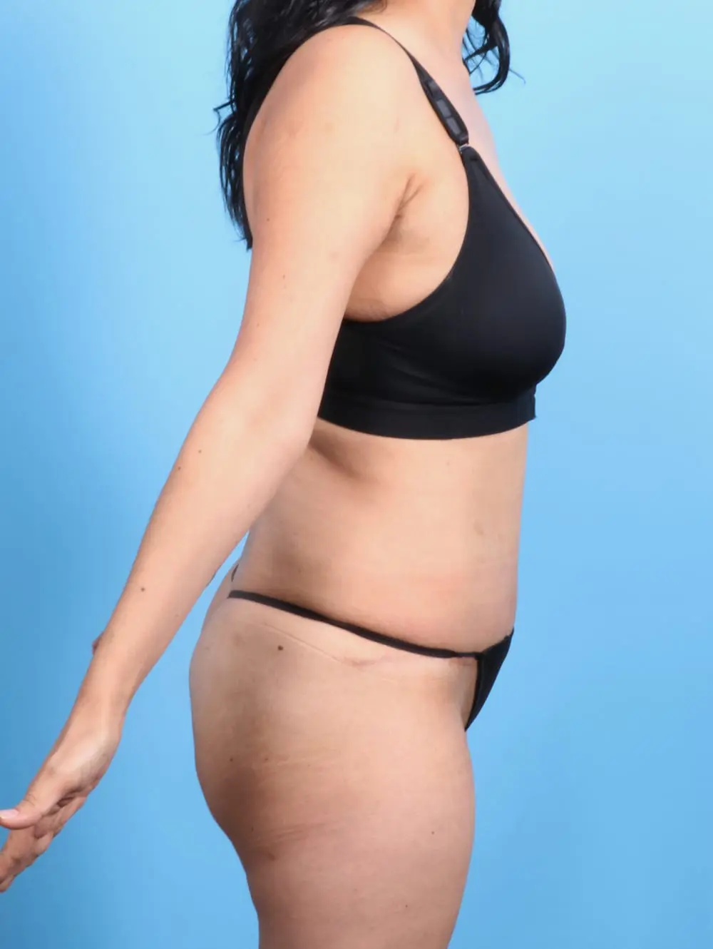 Tummy Tuck Patient Photo - Case 20296 - after view-2