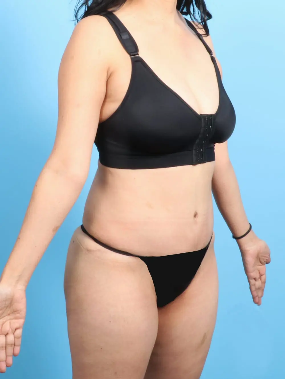 Tummy Tuck Patient Photo - Case 20296 - after view-1