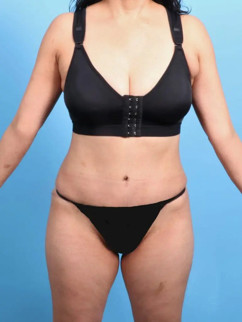 Tummy Tuck - Case 20296 - After