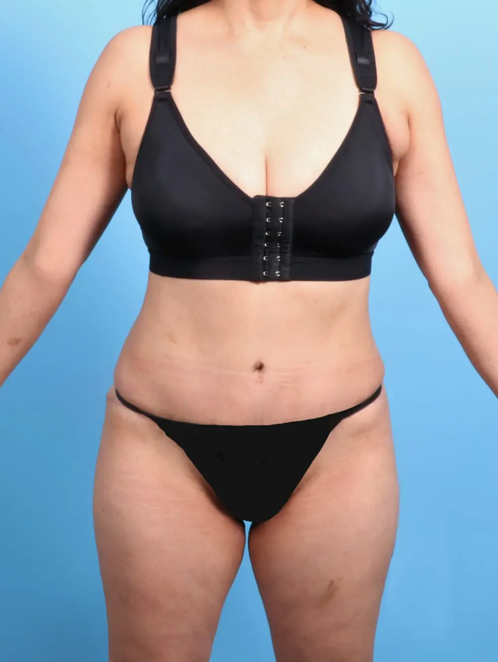 Tummy Tuck Patient Photo - Case 20296 - after view
