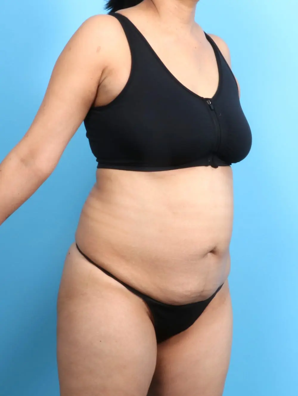 Tummy Tuck Patient Photo - Case 20296 - before view-1