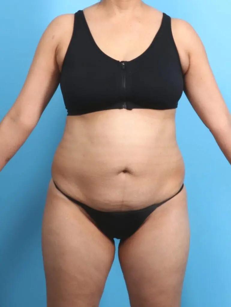 Tummy Tuck - Case 20296 - Before