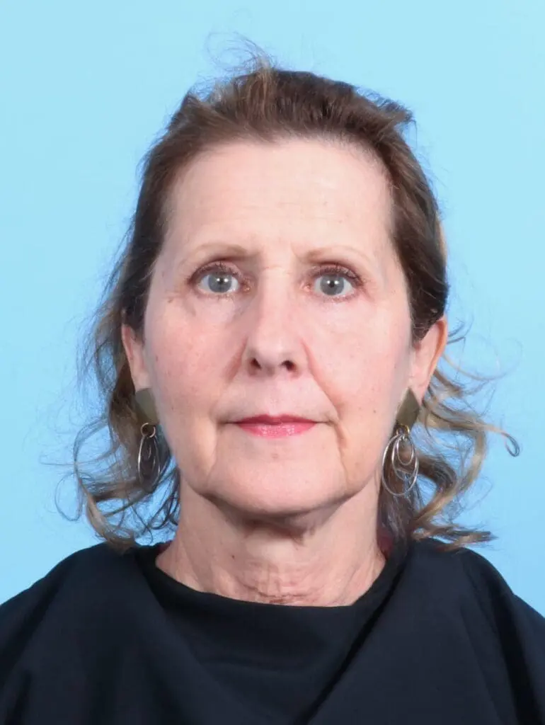 Eyelid Surgery - Case 20306 - After