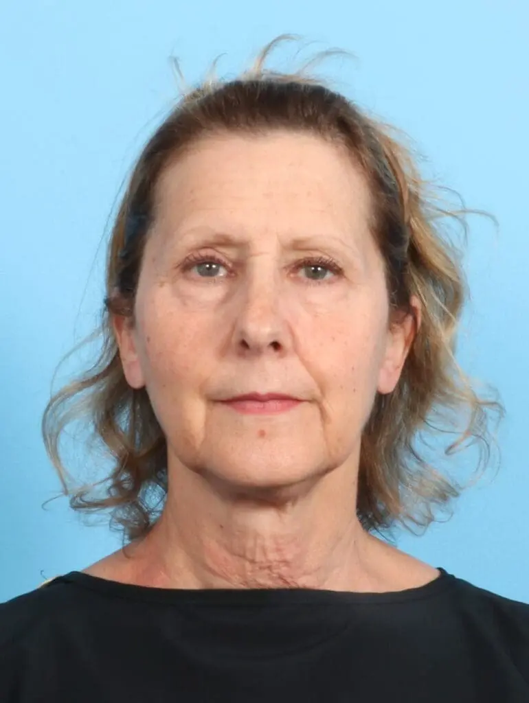 Eyelid Surgery - Case 20306 - Before