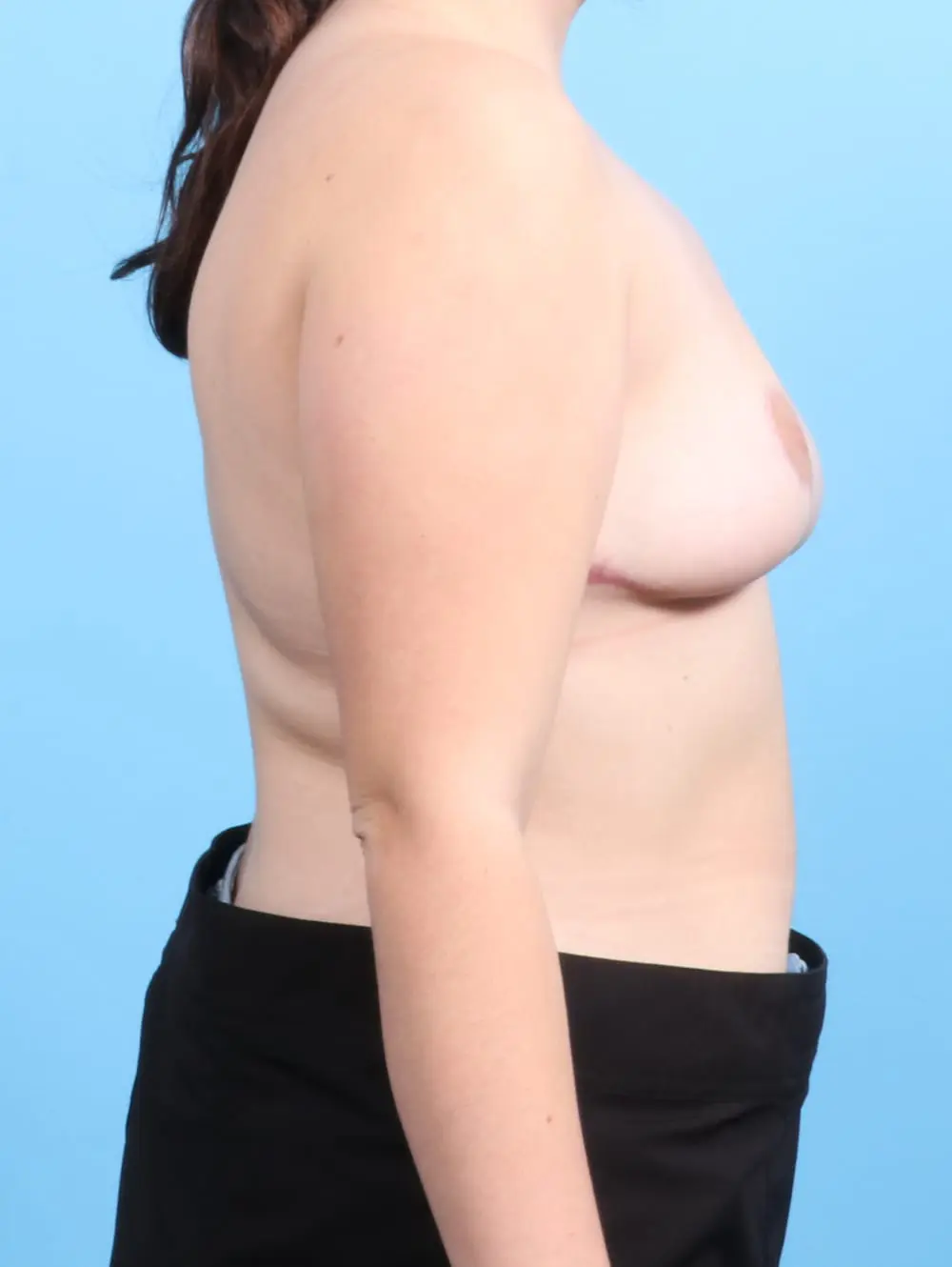 Breast Lift/Reduction w/o Implants Patient Photo - Case 20314 - after view-2