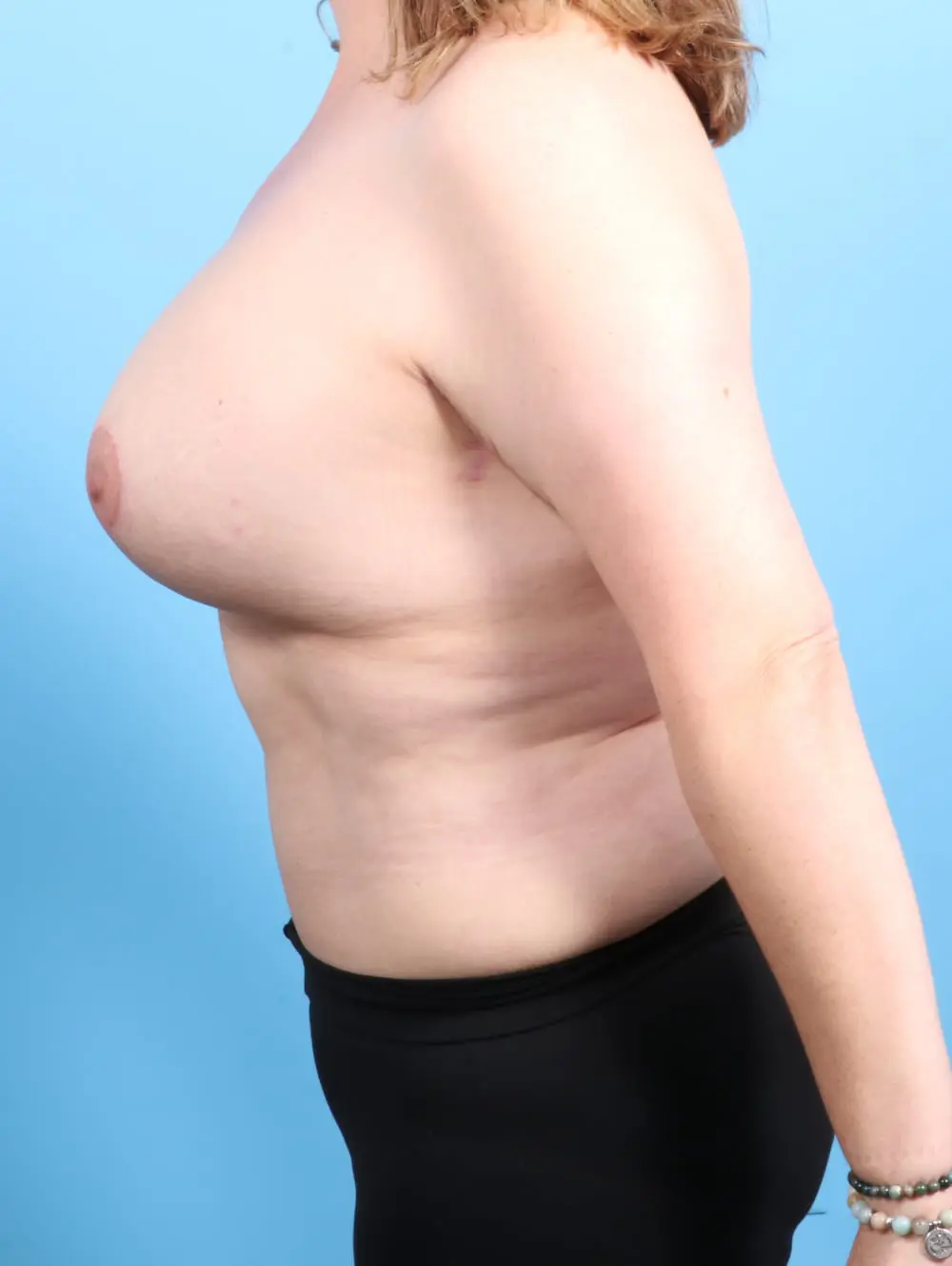 Breast Lift/Reduction with Implants Patient Photo - Case 20322 - after view-2