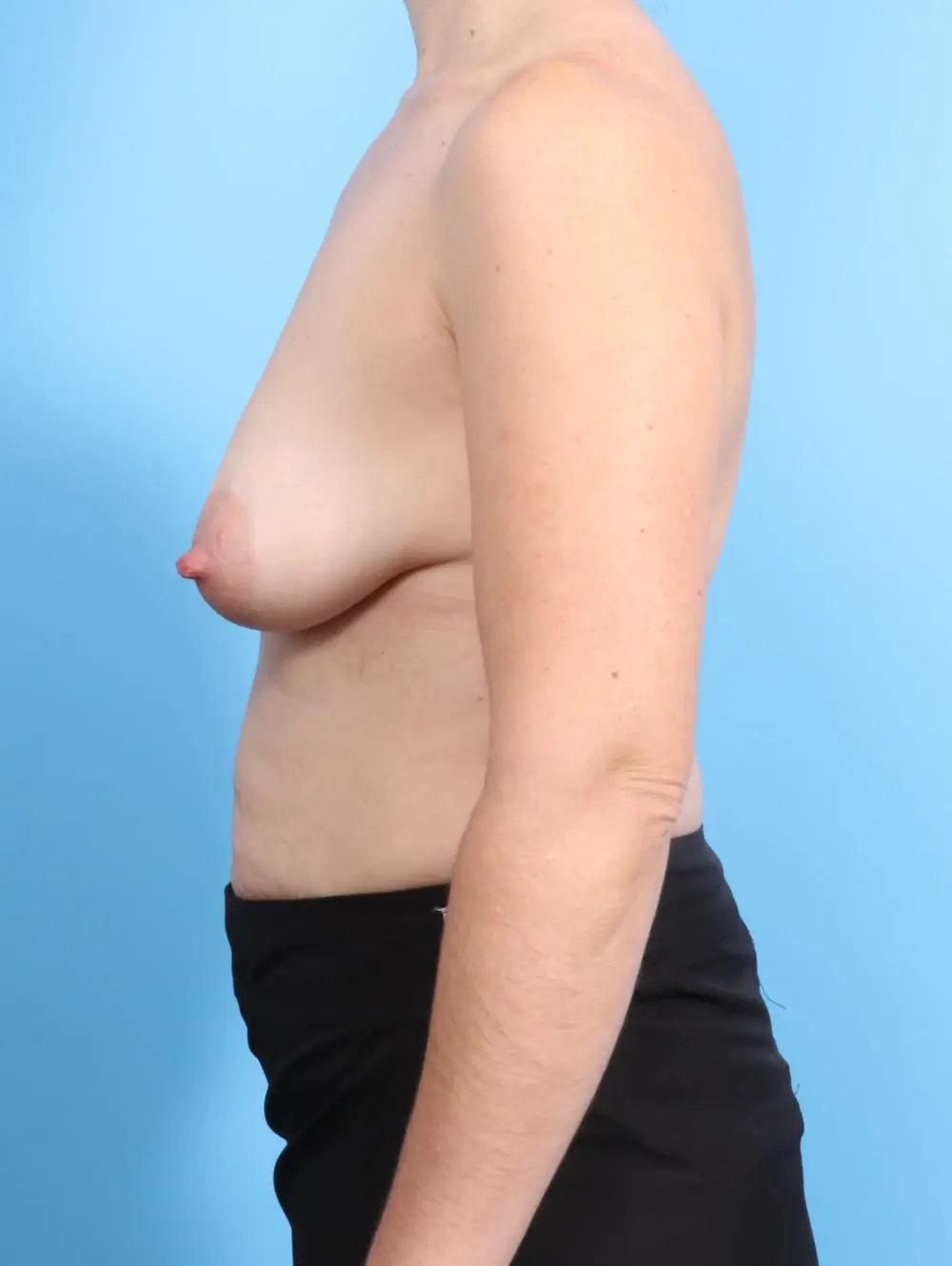 Breast Lift/Reduction with Implants Patient Photo - Case 20330 - before view-2