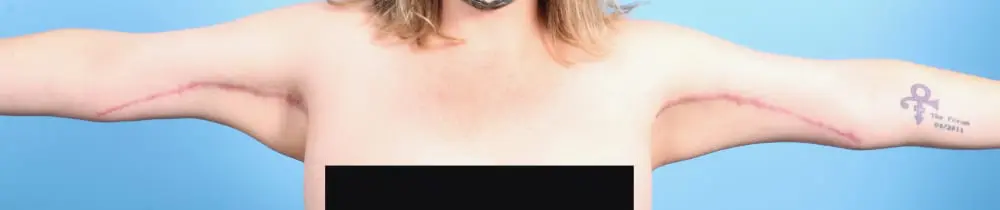 After Weight Loss Patient Photo - Case 20340 - after view-1