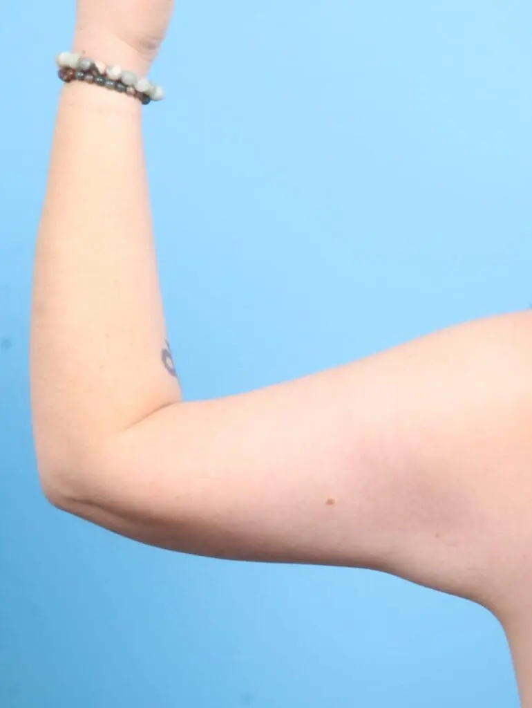 After Weight Loss - Case 20340 - After