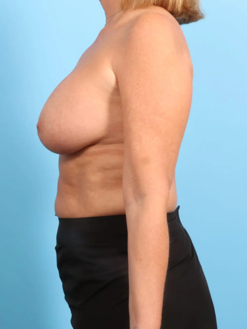 Breast Augmentation Patient Photo - Case 20348 - after view-2
