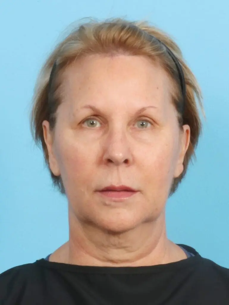 Facelift / Neck Lift - Case 20366 - Before