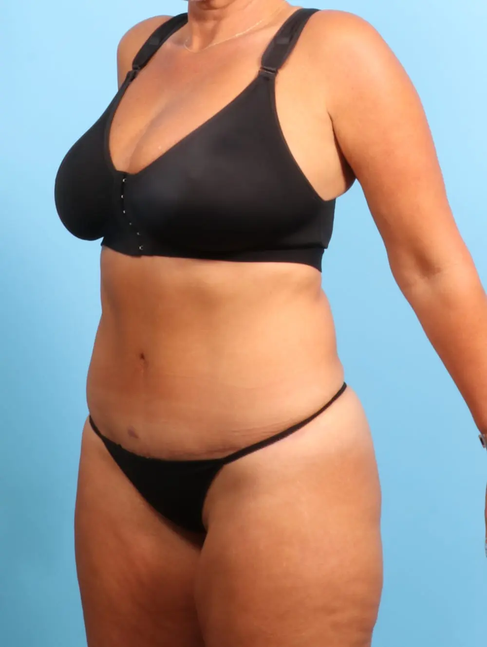 Tummy Tuck Patient Photo - Case 20382 - after view-1