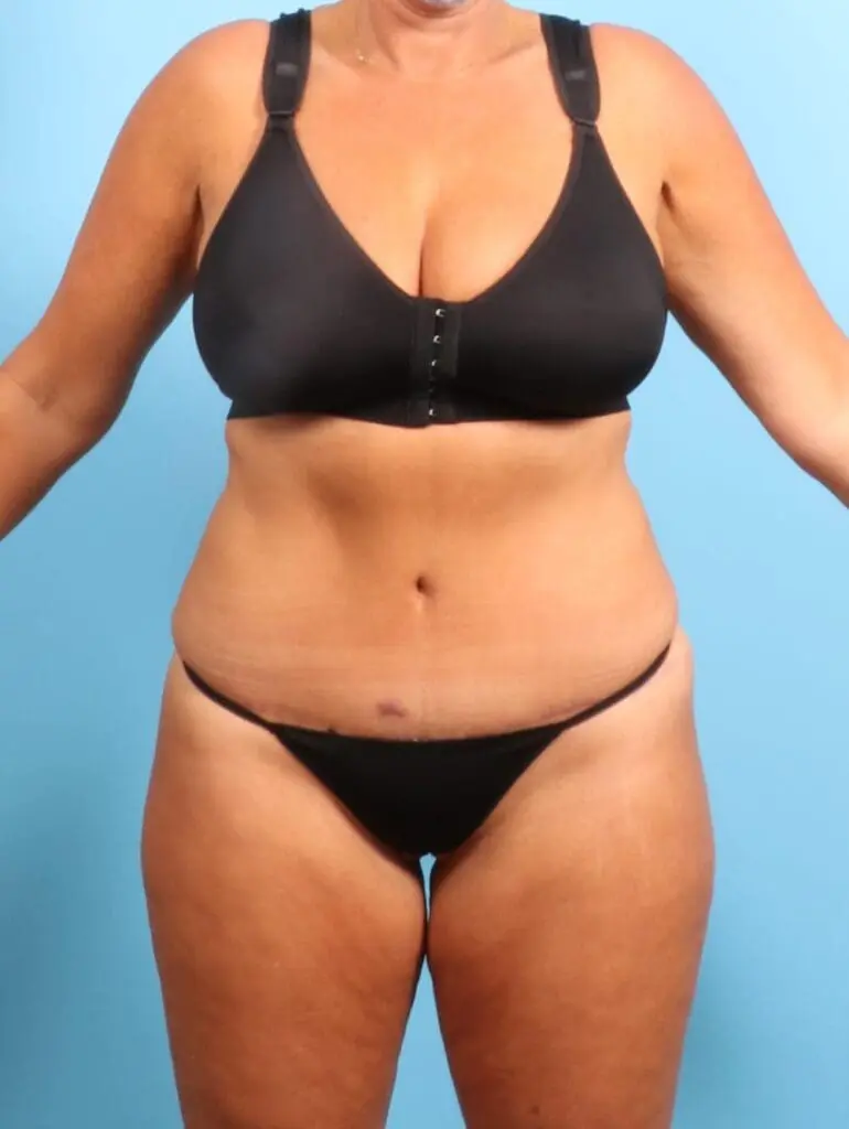 Tummy Tuck - Case 20382 - After