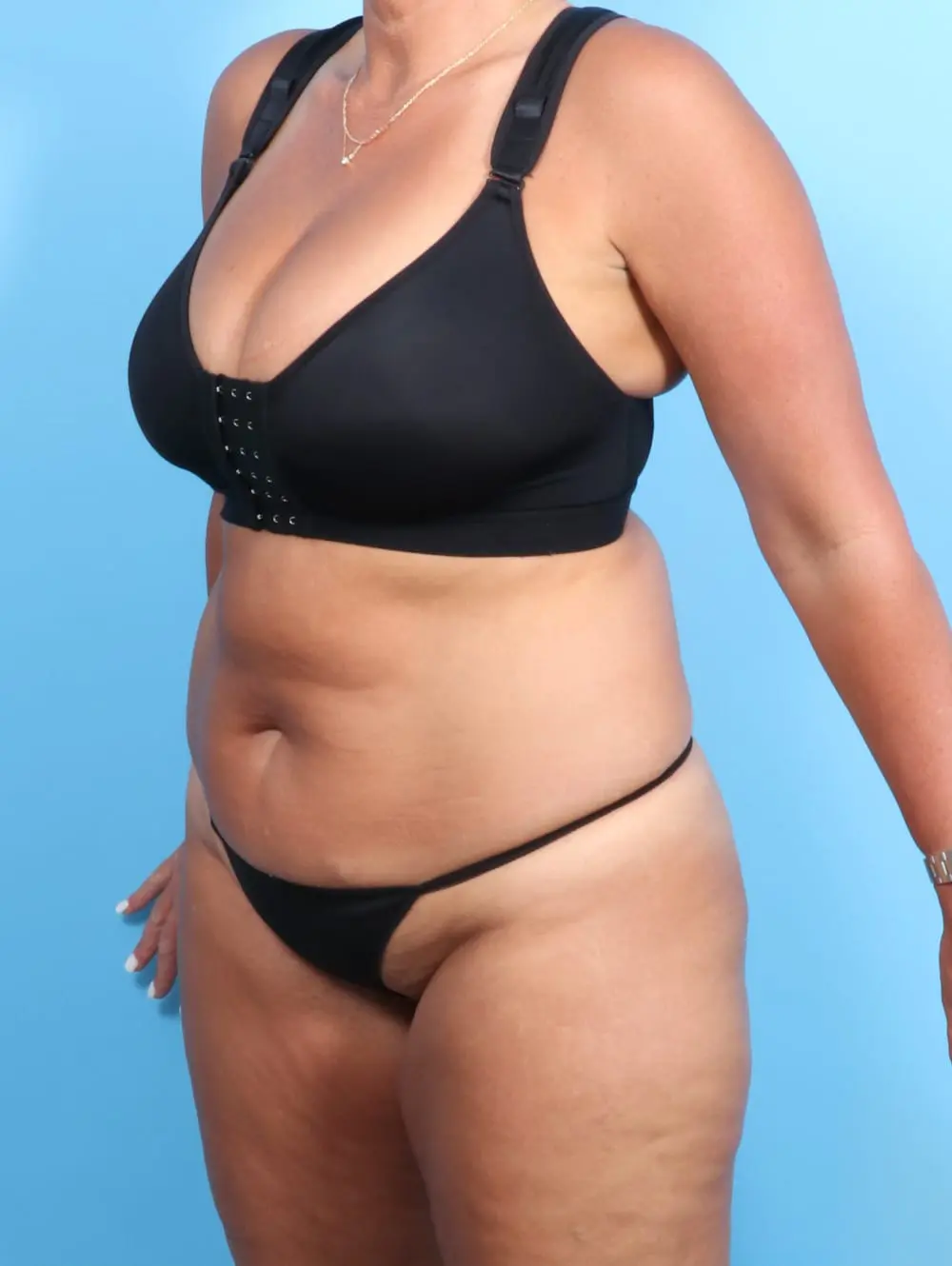 Tummy Tuck Patient Photo - Case 20382 - before view-1