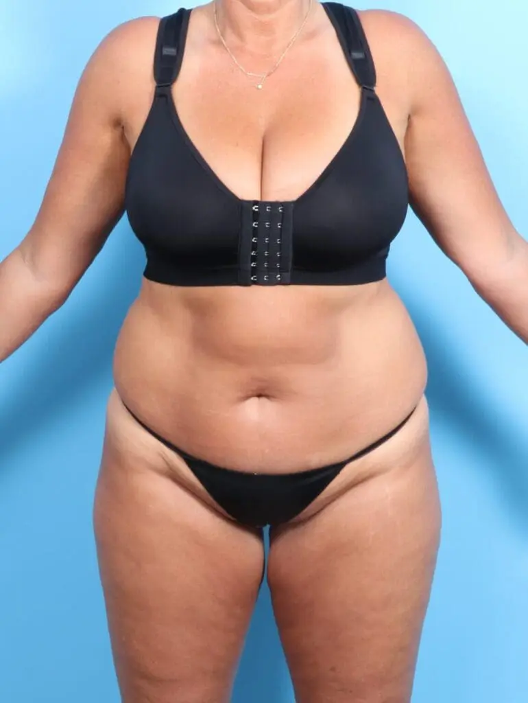 Tummy Tuck - Case 20382 - Before