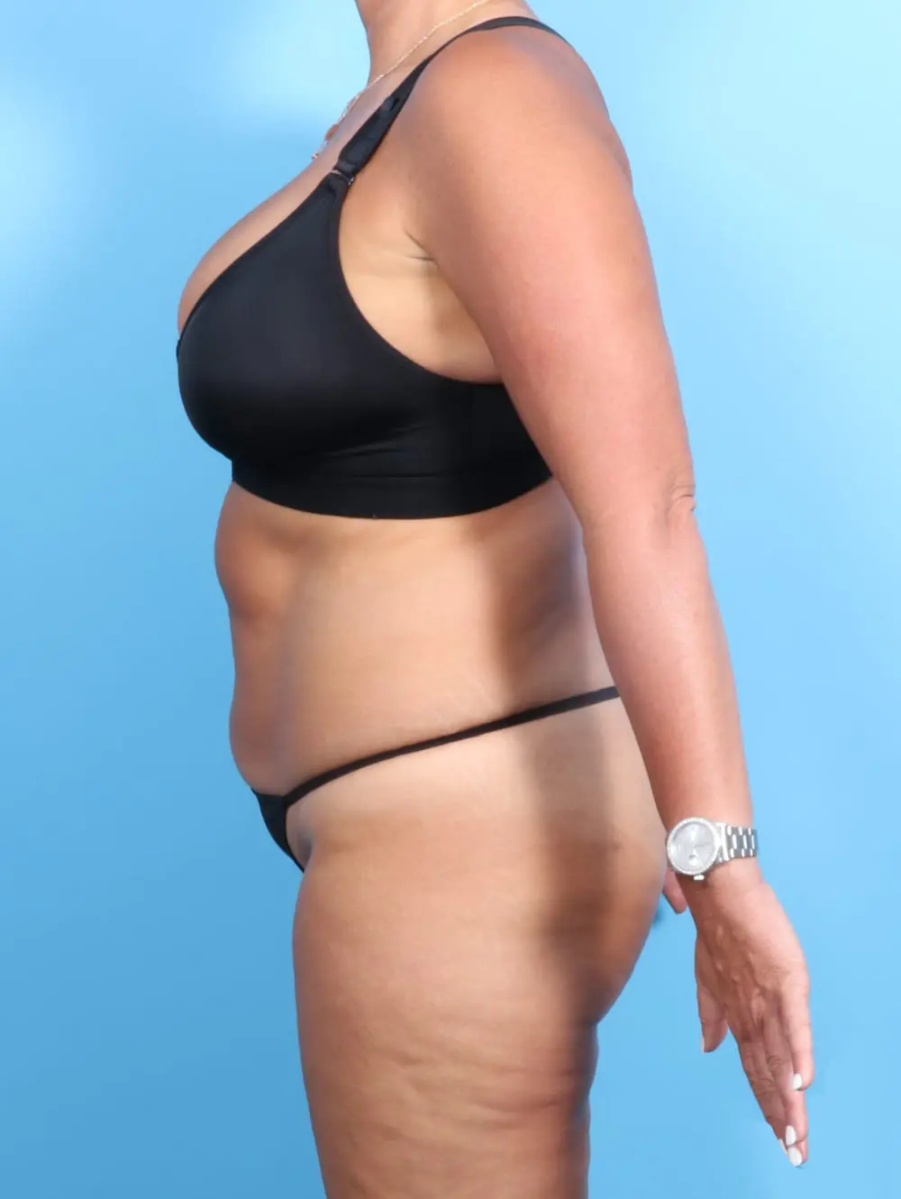 Tummy Tuck Patient Photo - Case 20382 - before view-2