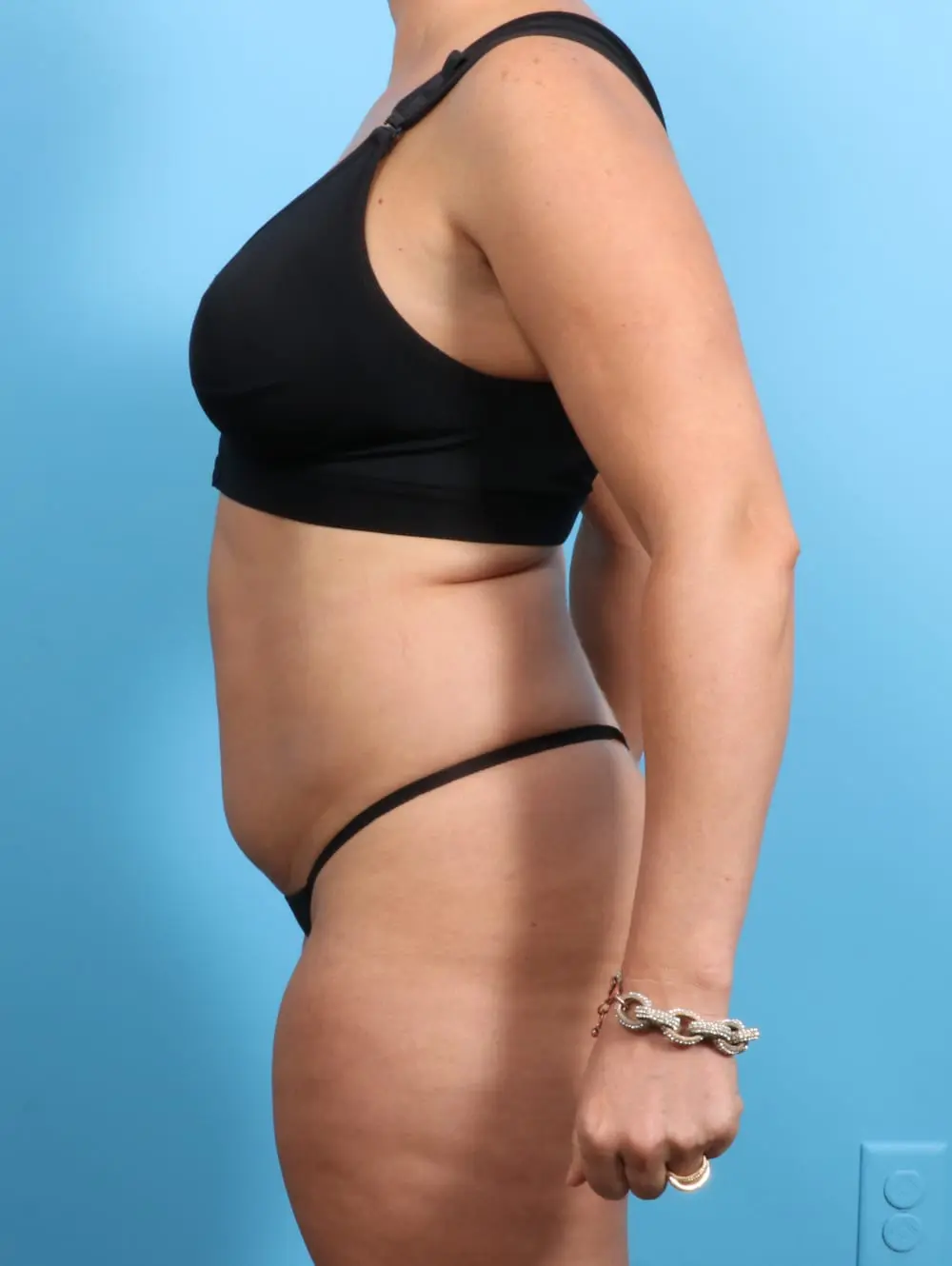 Ledgectomy Patient Photo - Case 20390 - before view-2