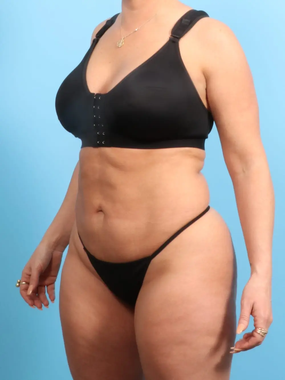 Ledgectomy Patient Photo - Case 20390 - after view-1