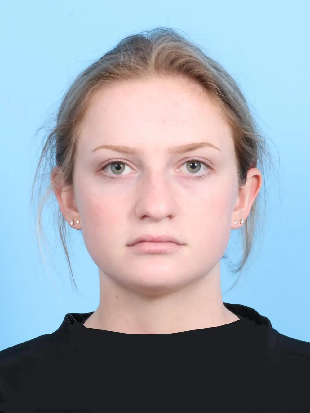 Rhinoplasty Patient Photo - Case 20424 - before view-2