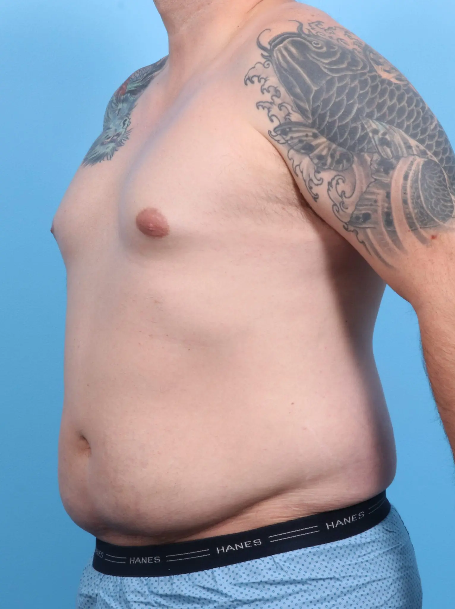 Male Liposuction Patient Photo - Case 20563 - before view-1