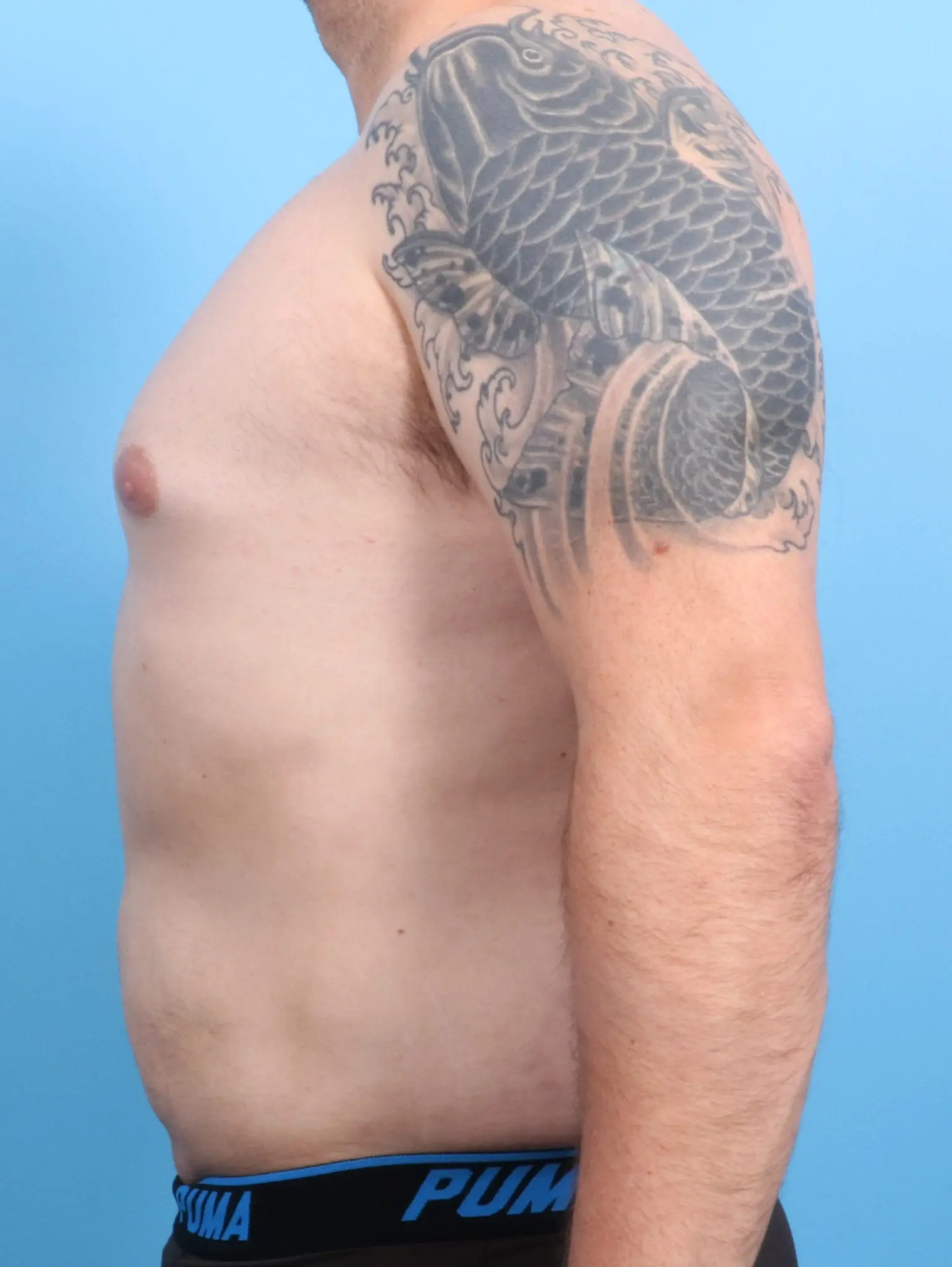 Male Liposuction Patient Photo - Case 20563 - after view-2