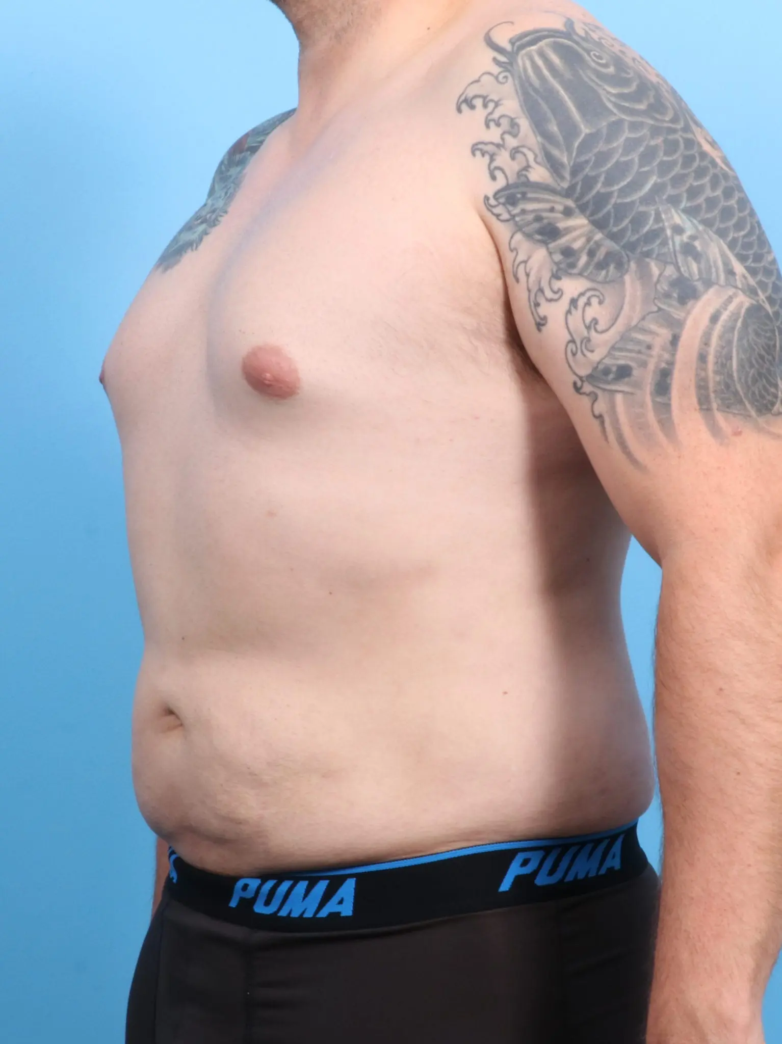 Male Liposuction Patient Photo - Case 20563 - after view-1