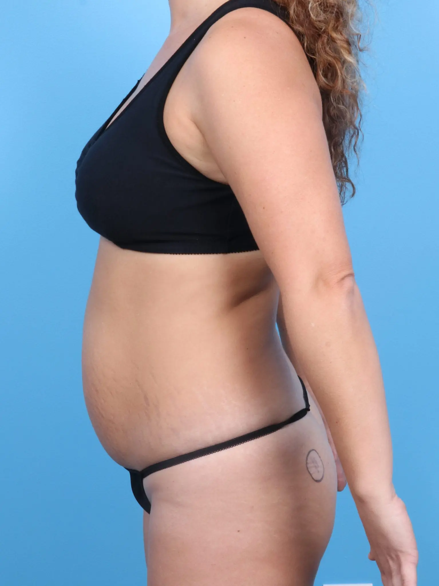 Liposuction Patient Photo - Case 20571 - before view-2