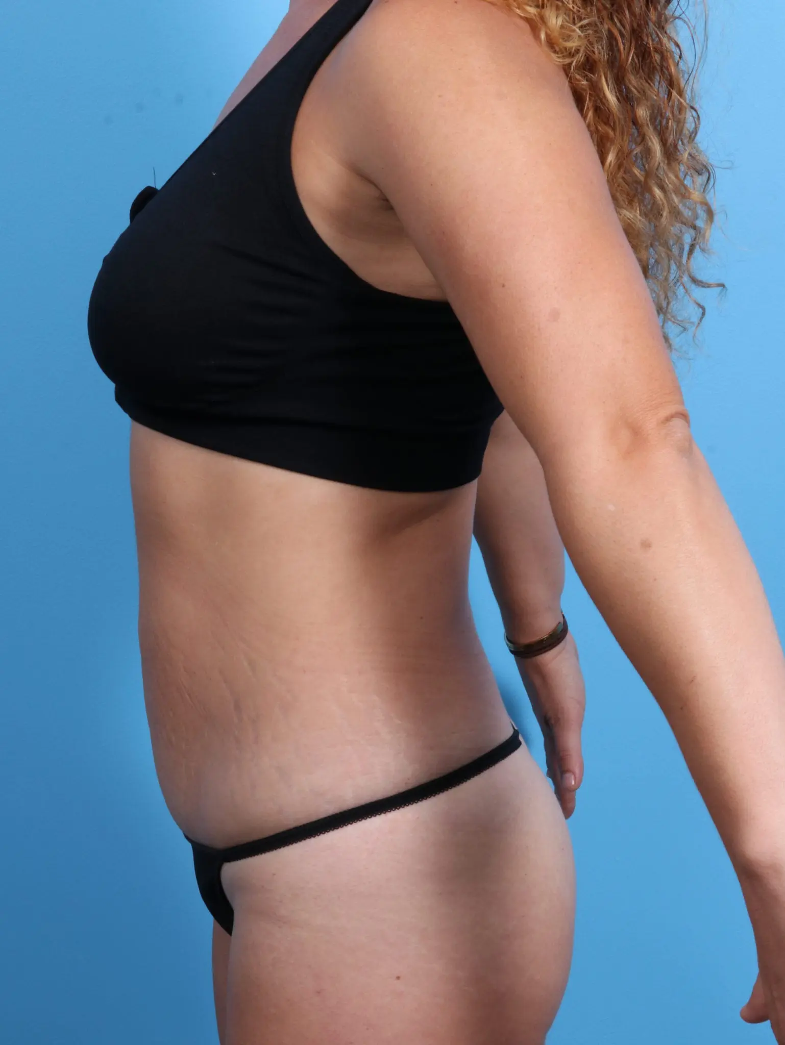 Liposuction Patient Photo - Case 20571 - after view-2