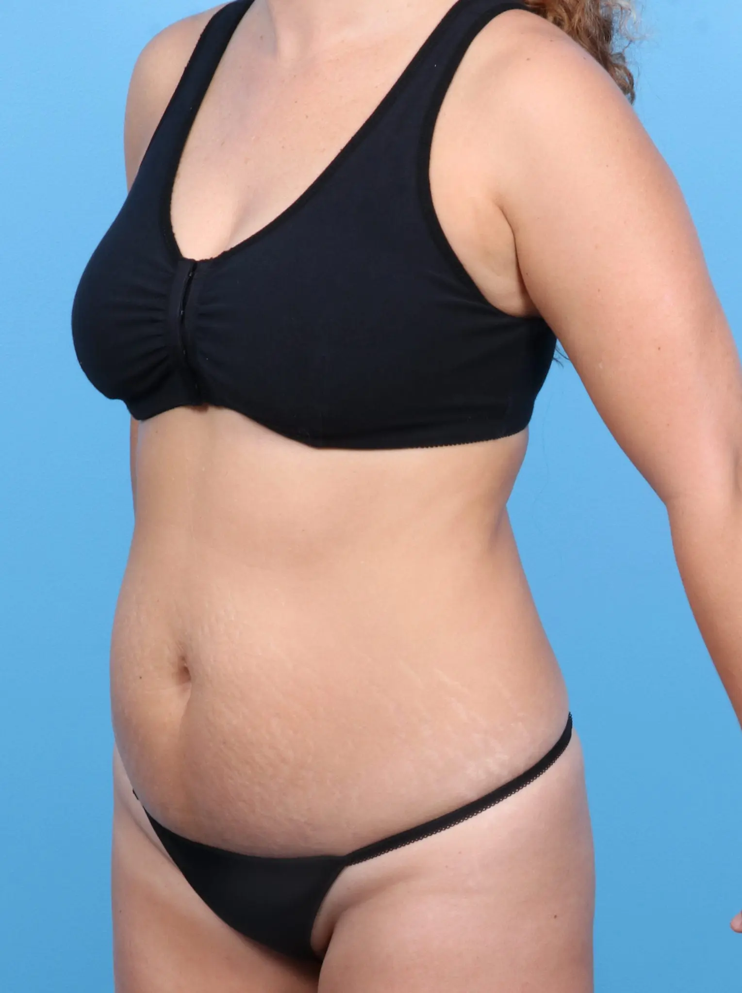 Liposuction Patient Photo - Case 20571 - before view-1