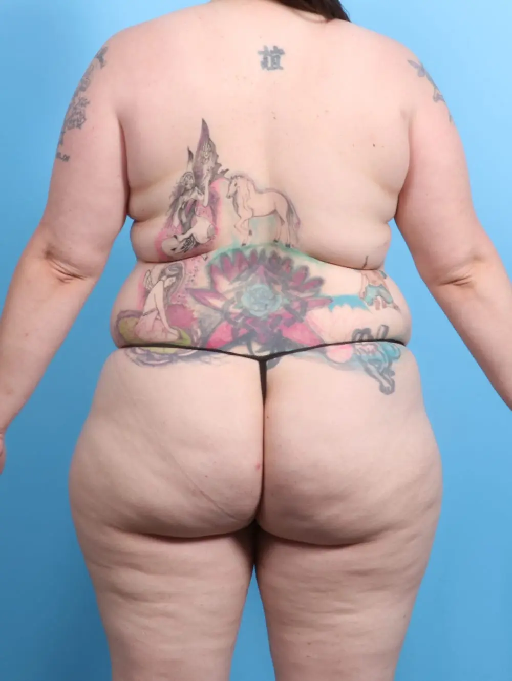 After Weight Loss Patient Photo - Case 20579 - before view-3