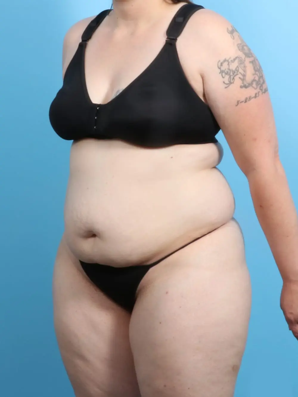 After Weight Loss Patient Photo - Case 20579 - before view-1