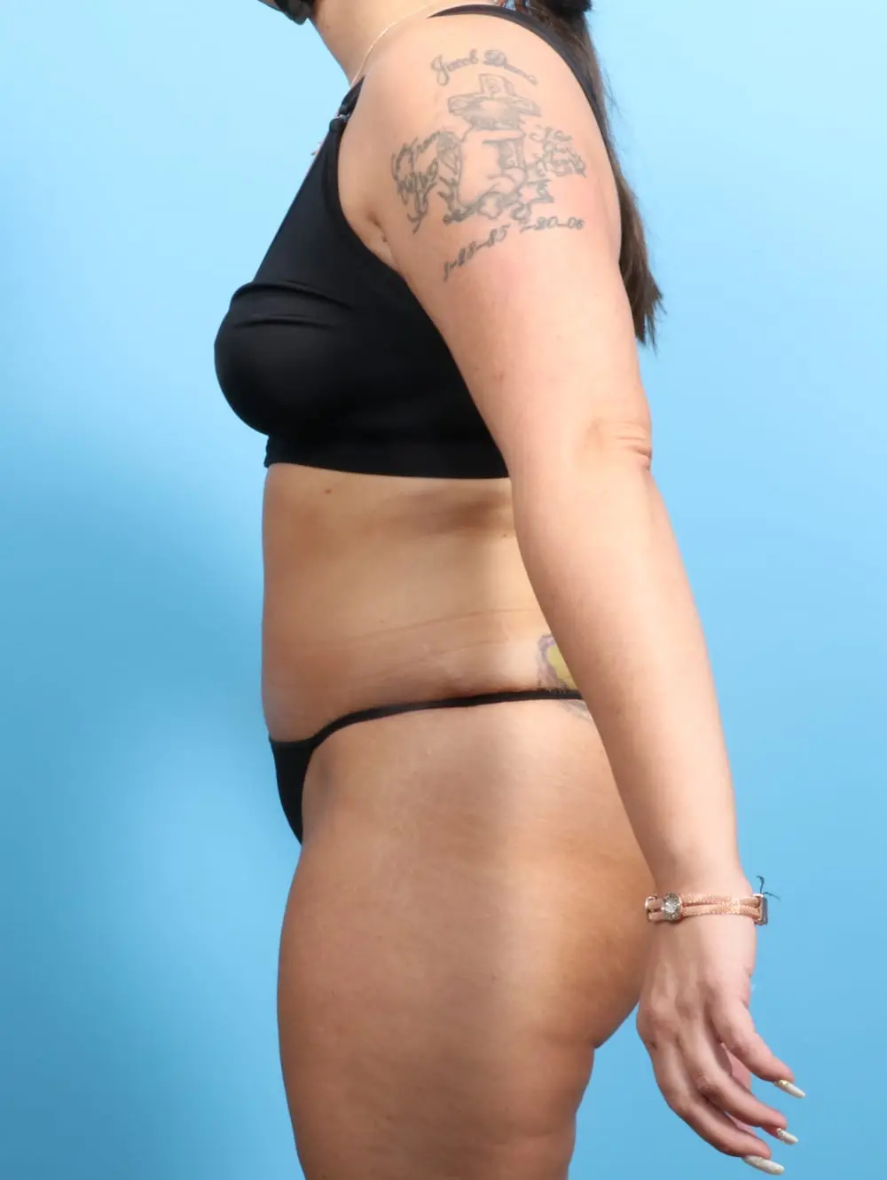 After Weight Loss Patient Photo - Case 20579 - after view-2