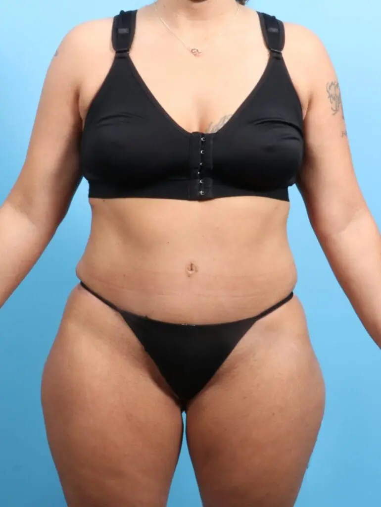 After Weight Loss - Case 20579 - After