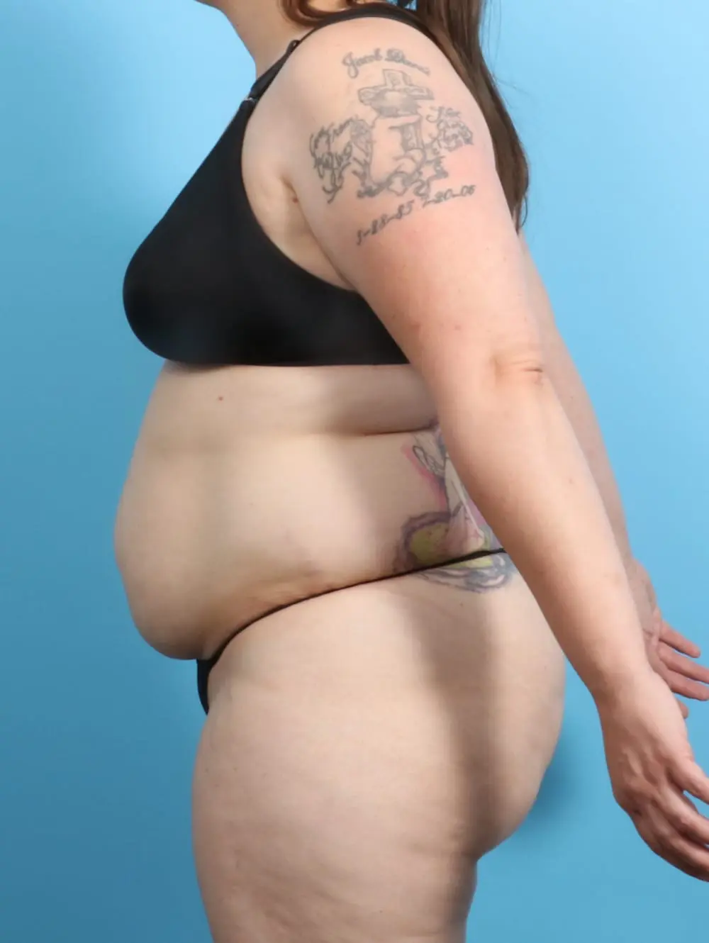 After Weight Loss Patient Photo - Case 20579 - before view-2