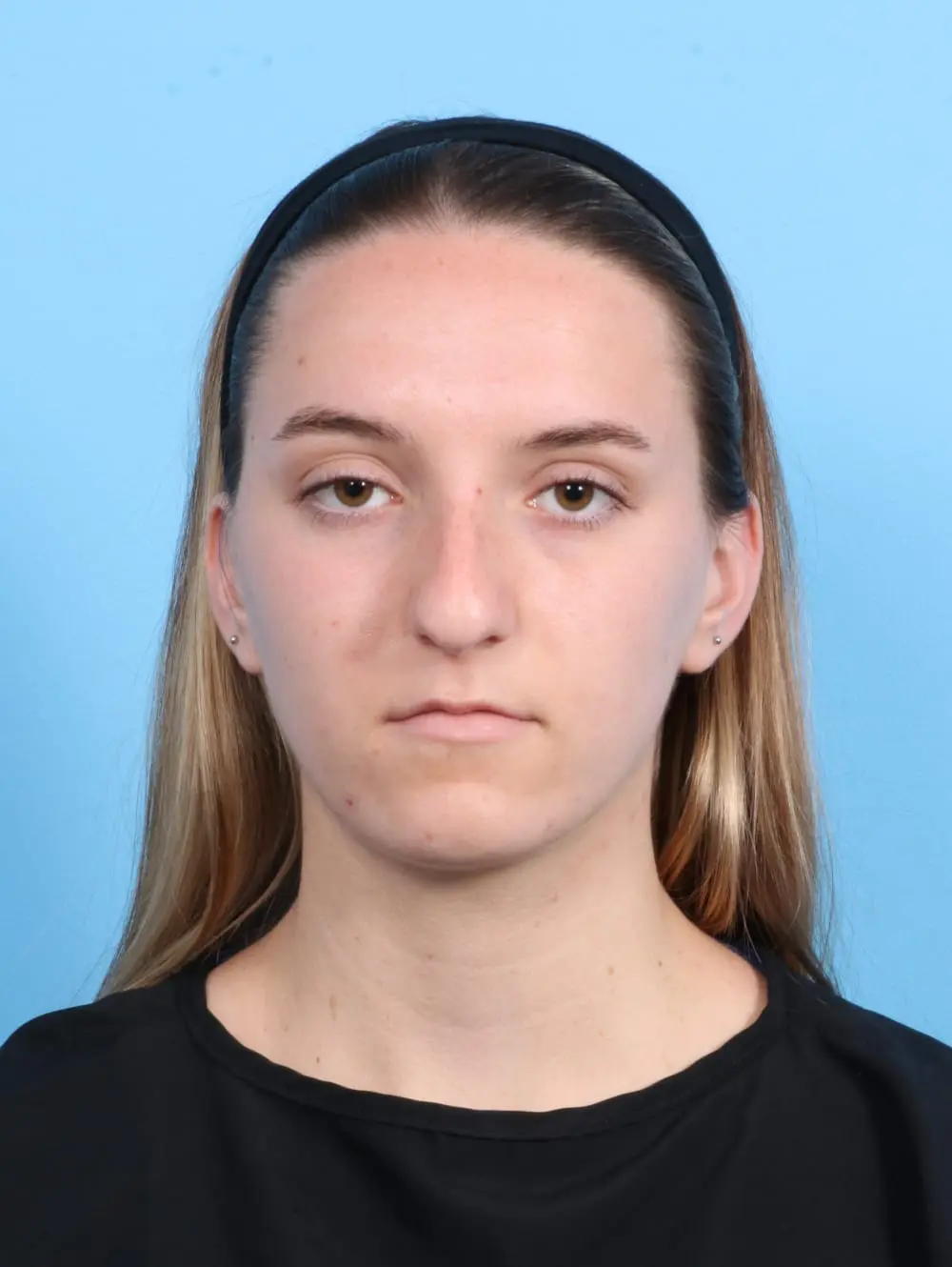 Rhinoplasty Patient Photo - Case 20604 - before view-1