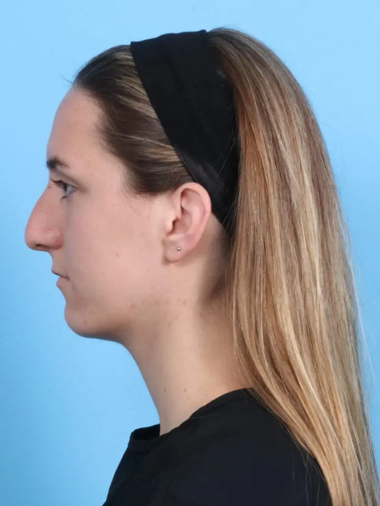 Rhinoplasty - Case 20604 - Before