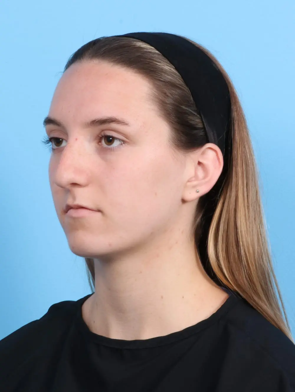 Rhinoplasty Patient Photo - Case 20604 - before view-2