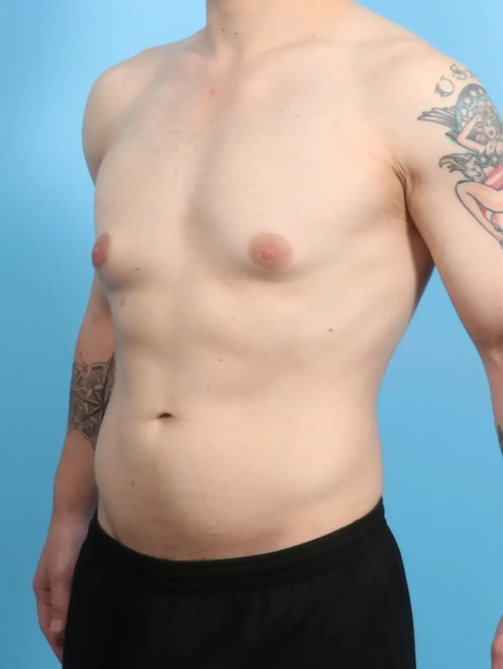 Gynecomastia Patient Photo - Case 20612 - before view-1