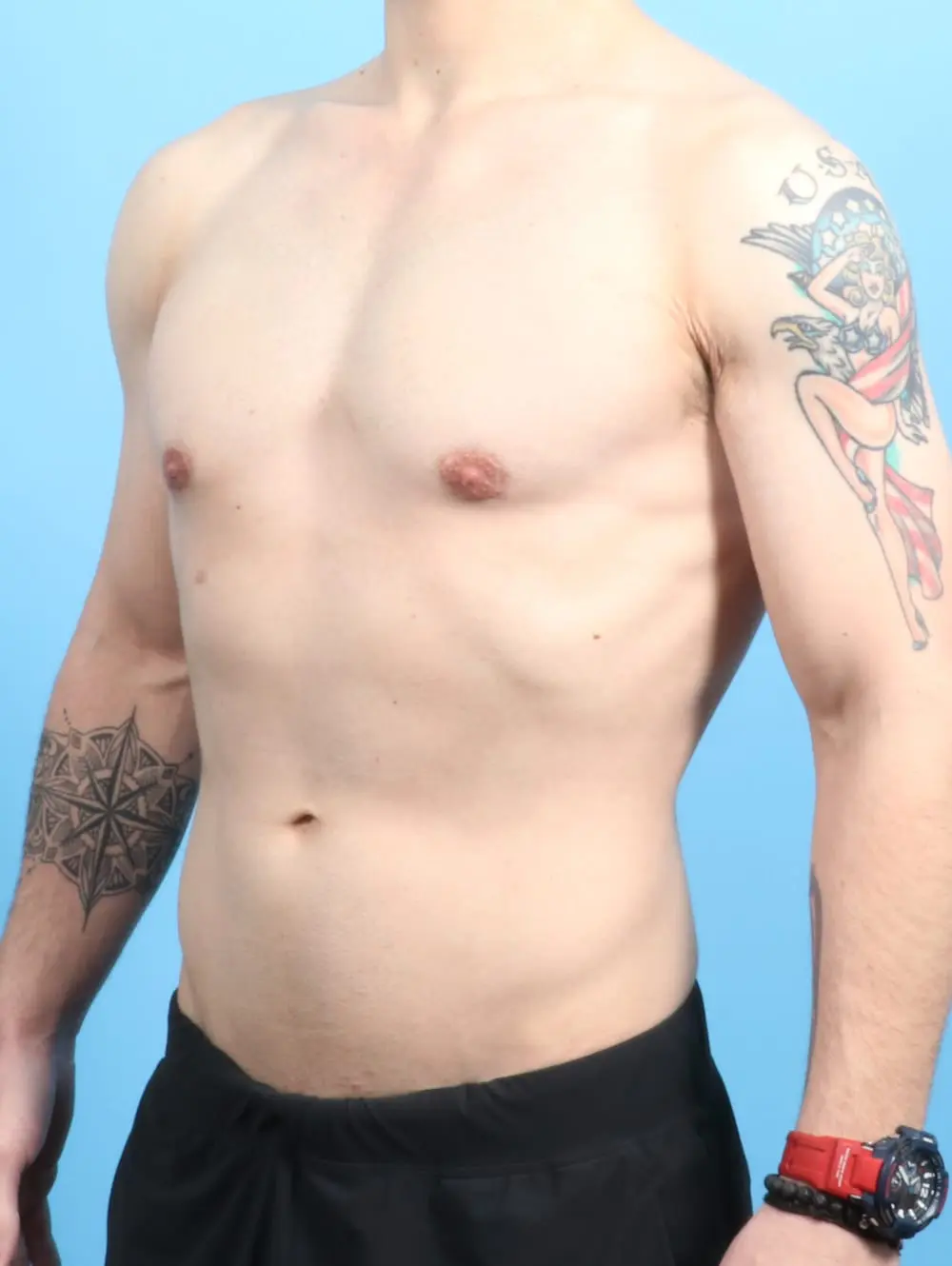 Gynecomastia Patient Photo - Case 20612 - after view-1