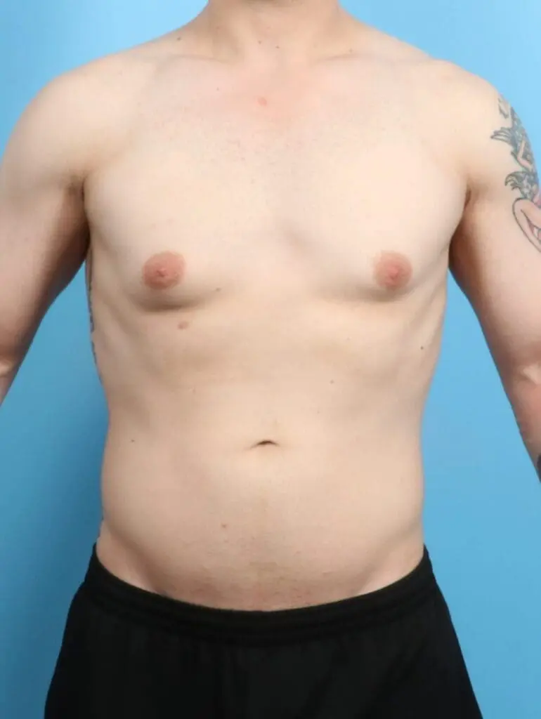 Gynecomastia - Case 20612 - Before