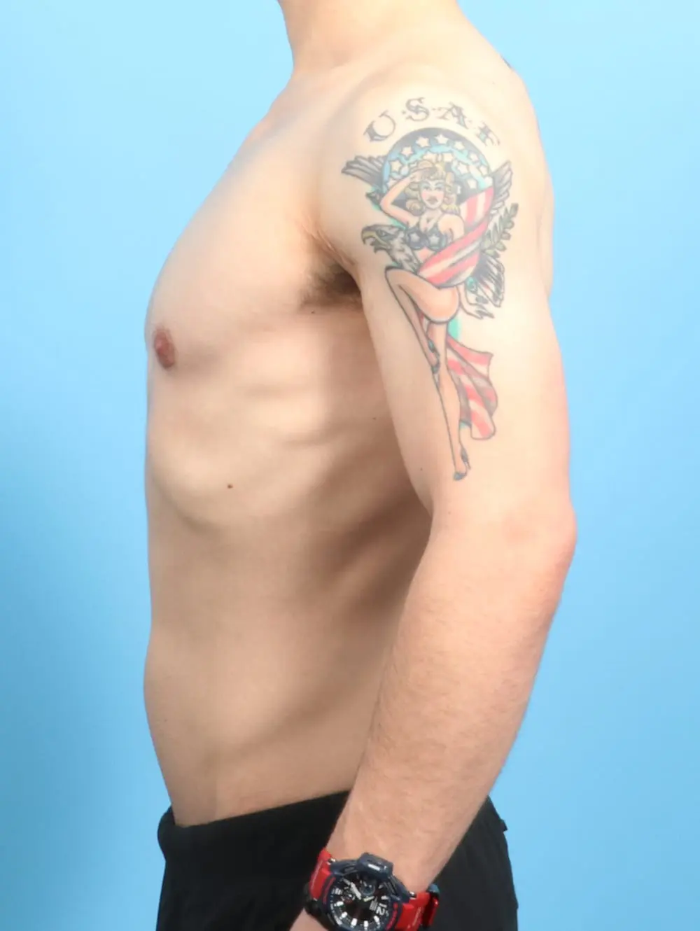 Gynecomastia Patient Photo - Case 20612 - after view-2