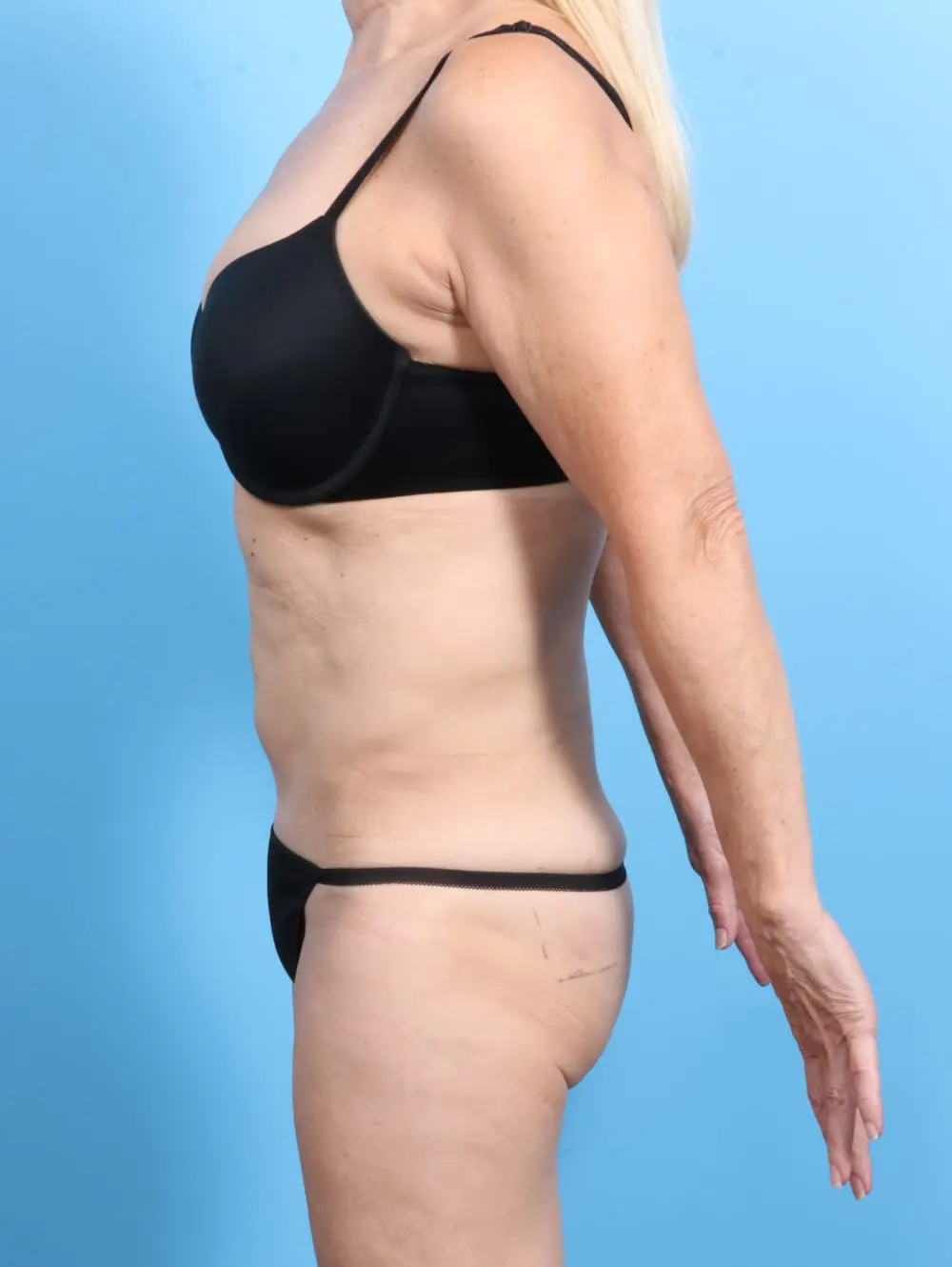 Tummy Tuck Patient Photo - Case 20620 - before view-2