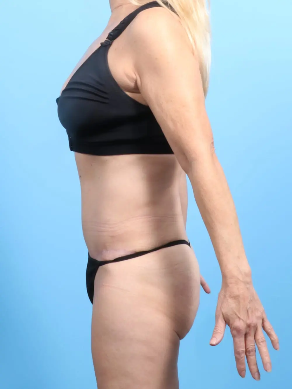 Tummy Tuck Patient Photo - Case 20620 - after view-2