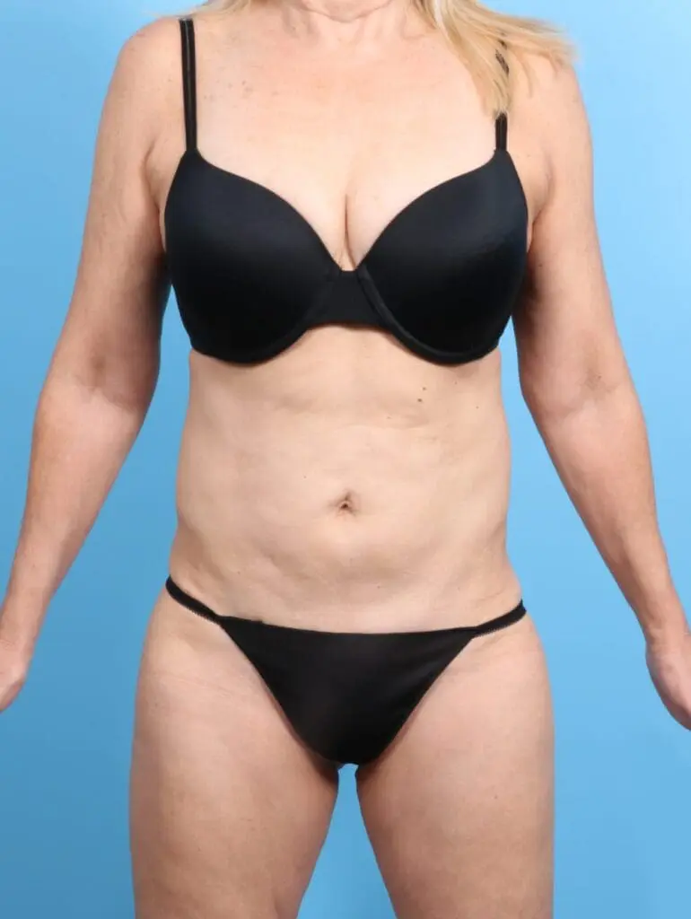 Tummy Tuck - Case 20620 - Before