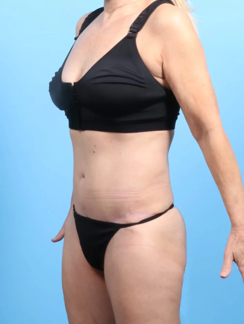 Tummy Tuck Patient Photo - Case 20620 - after view-1