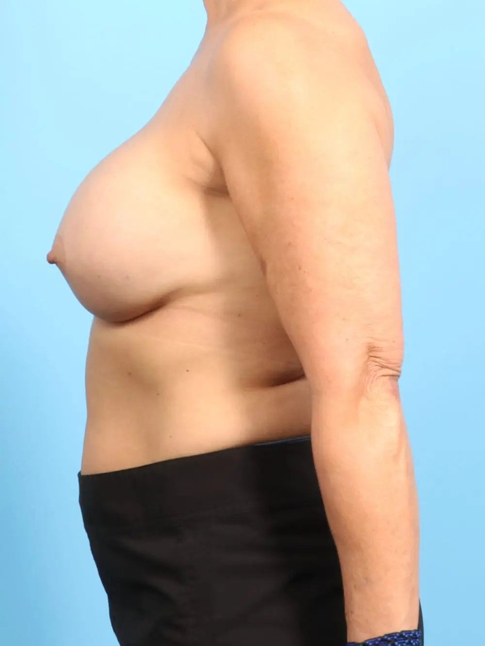 Breast Augmentation Patient Photo - Case 20629 - after view-2