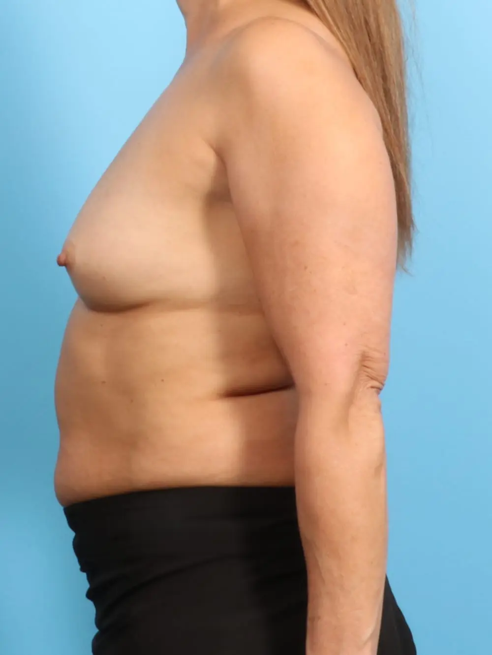 Breast Augmentation Patient Photo - Case 20629 - before view-2