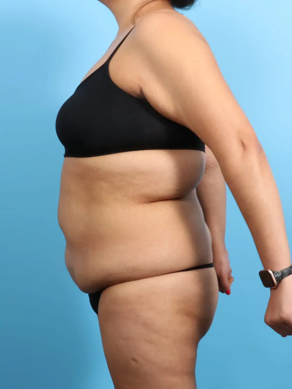 After Weight Loss Patient Photo - Case 20638 - before view-2