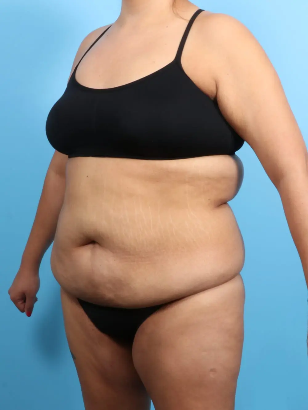 After Weight Loss Patient Photo - Case 20638 - before view-1